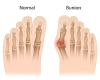 The Definition of a Bunion